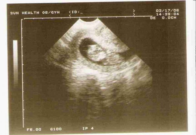 Pregnancy Checklist: Your 1st Trimester Firstultrasound Mar 17 2006