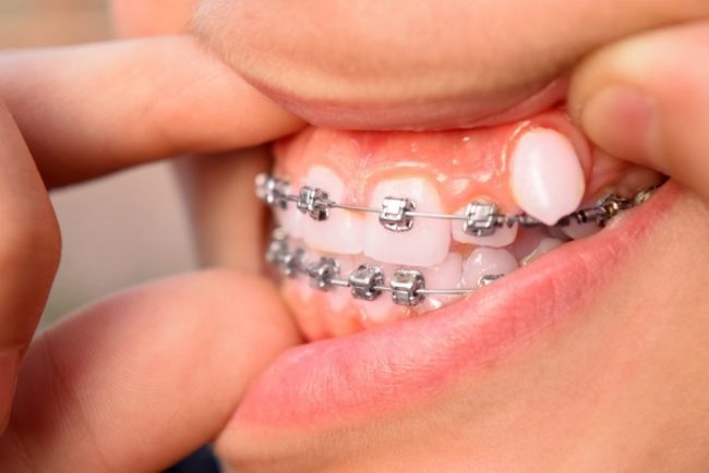 Our Experience So Far With Braces ES Progress