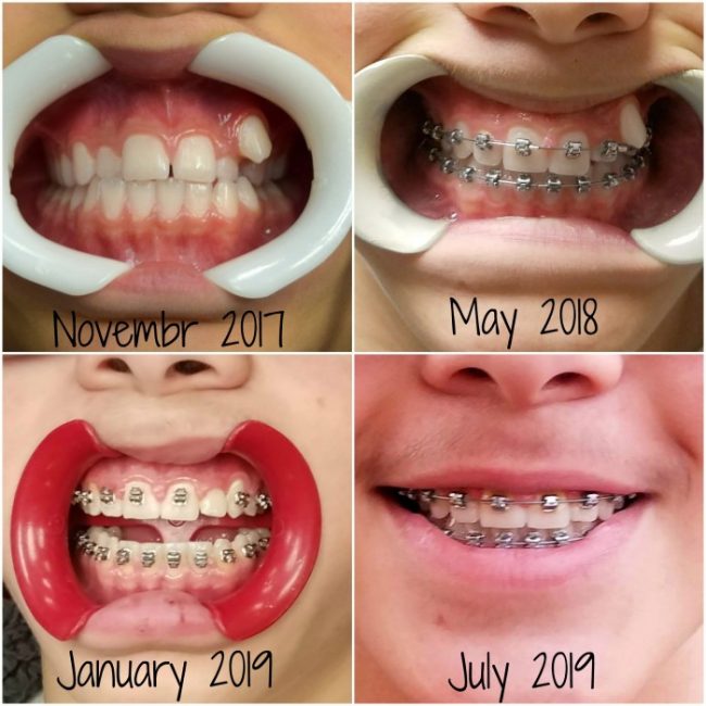 What to Expect: Almost Done with Braces - A Mom's Take