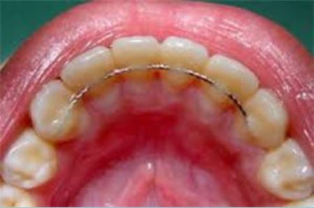 What to Expect: Almost Done with Braces 3 This image has an empty alt attribute; its file name is Fixed-Retainer.jpg